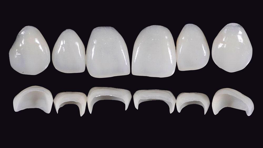 Prosthetic Rehabilitation on Natural Teeth – Predictable, Esthetic and Systematic Steps