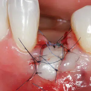 Soft Tissue Management around Natural Teeth and Dental Implants Online Master Class | Jovanovic