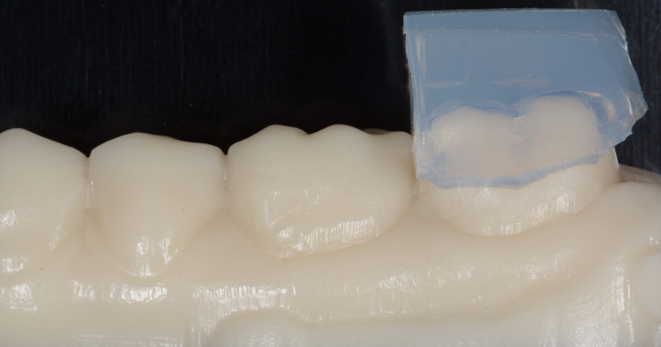 Direct and Indirect Adhesive Restorations – Minimal Invasive Treatment of the Anterior and Posterior Damaged Dentition using Direct Bonded Restorations
