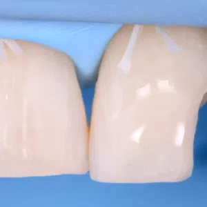 Direct and Indirect Adhesive Restorations Online Master Class | Ammannato