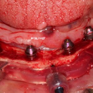 Implant Online Certificate Program | Jovanovic & Guest Faculty