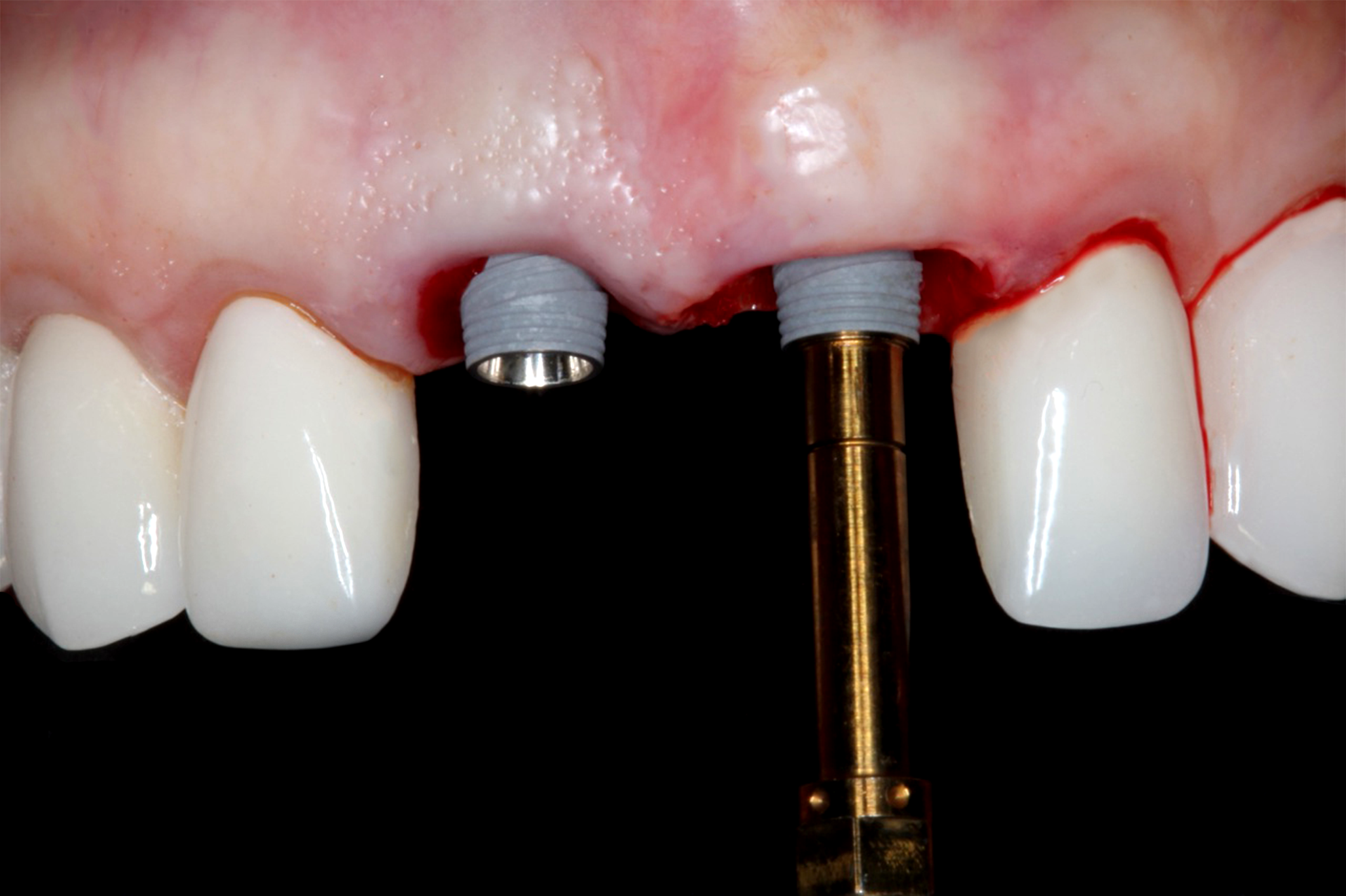 Online Certificate Program in Implant Dentistry