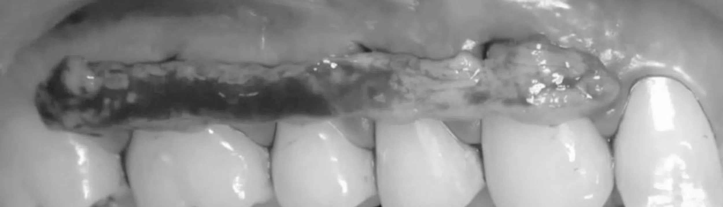 Tunneling & Mucogingival Therapy for Soft Tissue Management & Esthetics in 8 Videos | Kahn, Madison, Mintrone