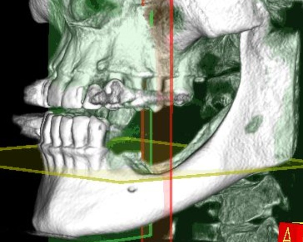 Vertical Ridge Augmentation in the posterior mandible using GBR with a TR-PTFE membrane