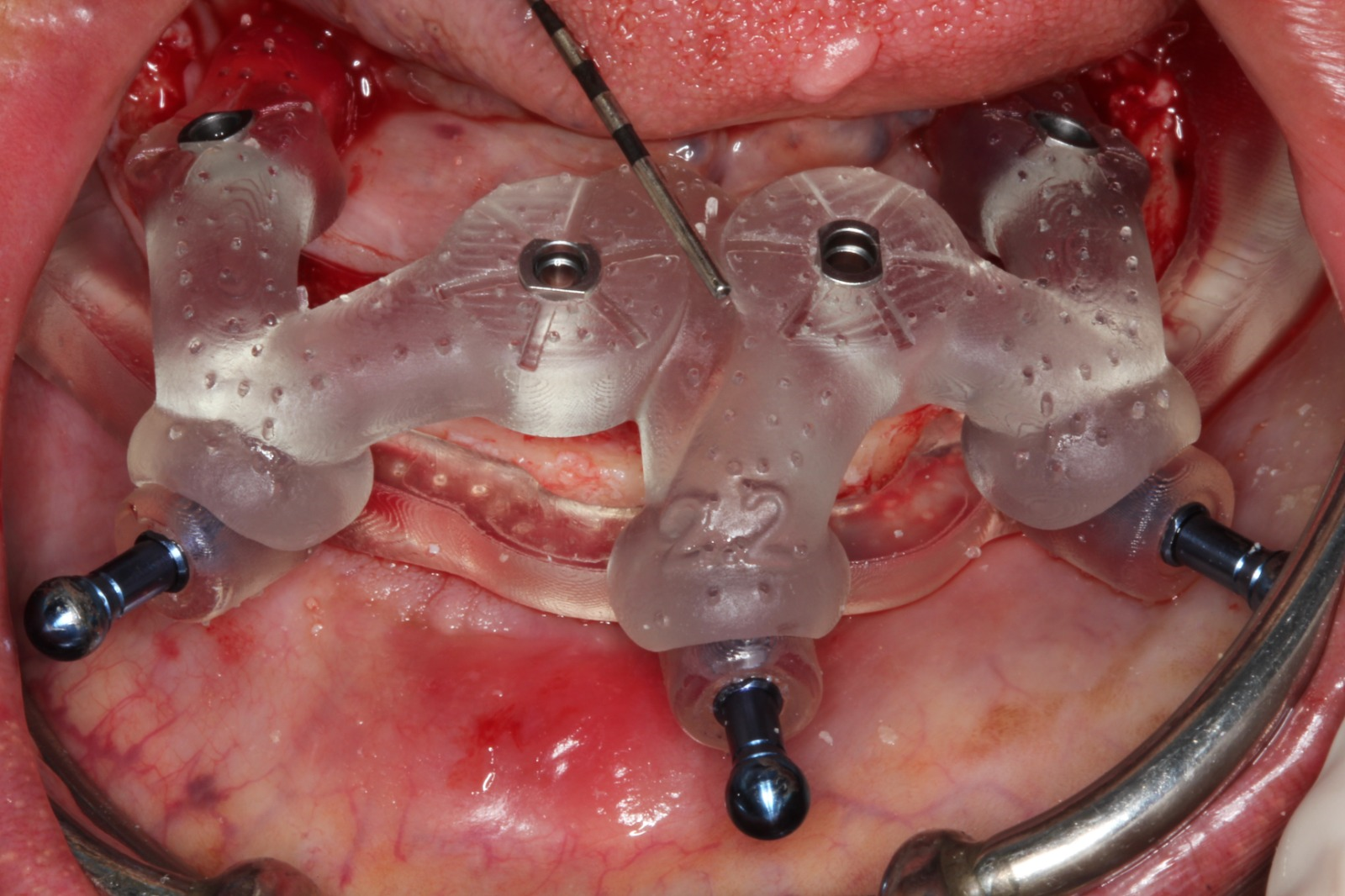 The Use of Stackable Guides for a Full Arch Treatment with 4 BLX Implants and an Immediate Printed Hybrid Prosthesis