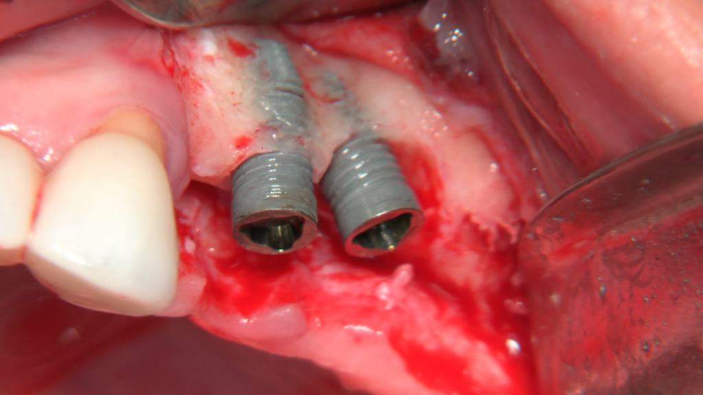 Periimplantitis Treatment for Two Long-Term Functioning Upper Implants