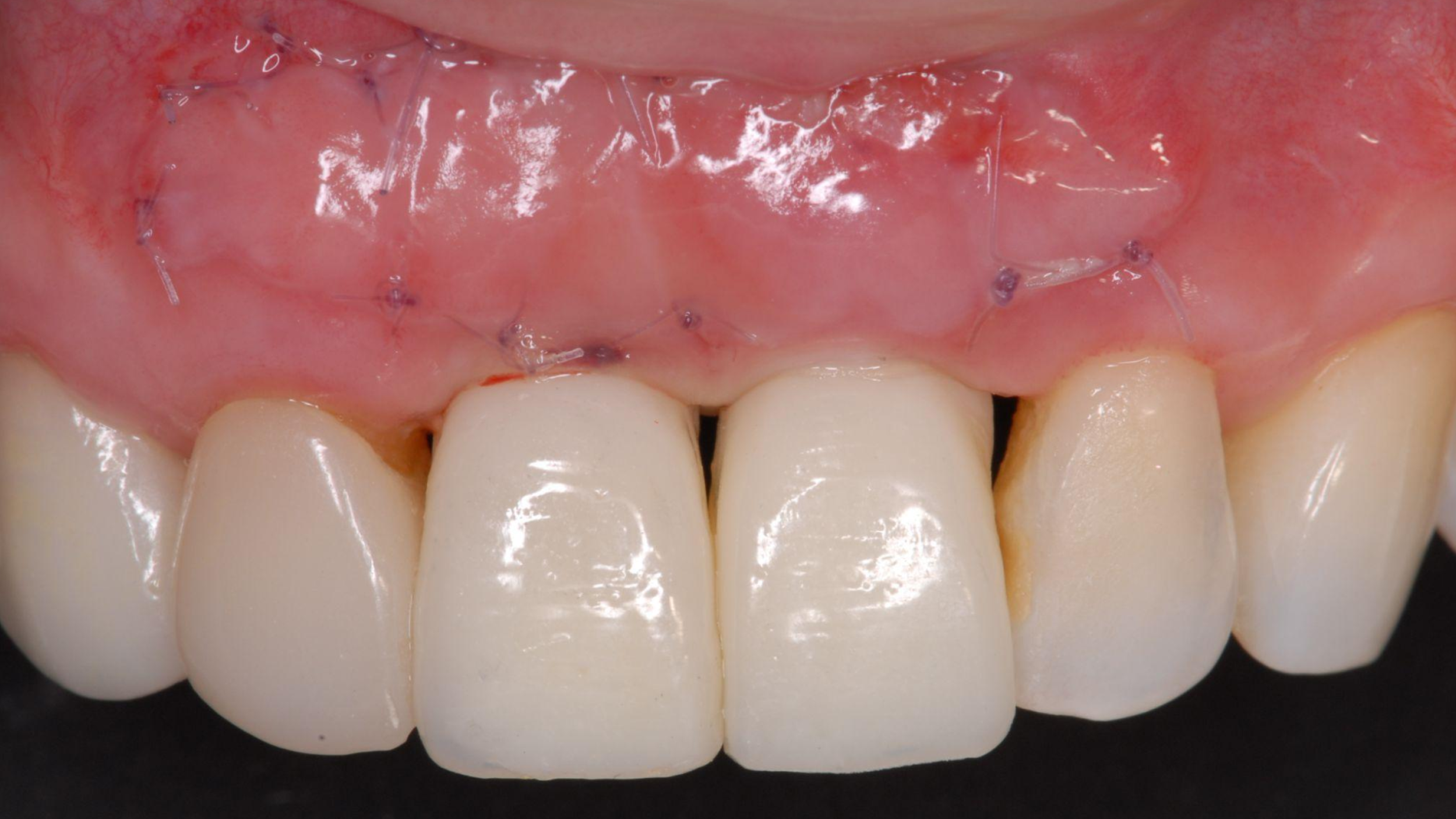 Uncovering and Temporization of 2 Anterior Implants with Mucogingival Surgery for Optimal Soft Tissue Healing